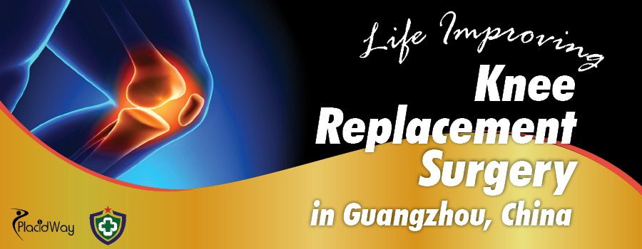 Life Improving Knee Replacement Surgery in Guangzhou, China